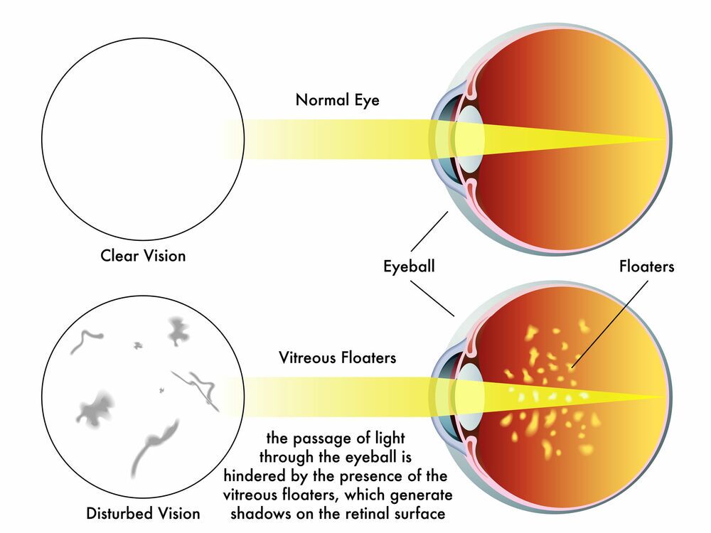 When To Be Concerned With Eye Floaters Eye Clinic Of Florida 